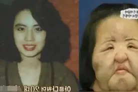 韩国“镜子公主”整容上瘾，自行注射大豆油，竟把脸整成电风扇图片