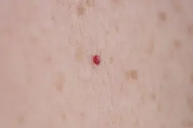 皮肤上长出的小红点，到底是什么？图片