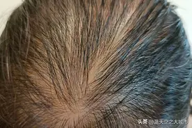 真相揭晓丨谁在掌握头发的生长大权？图片