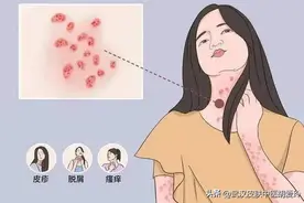 小臂患玫瑰糠疹，吃什么药可以解毒消除色素沉着呢？图片