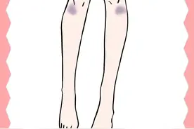 为什么女生的膝盖上总有淤青？图片