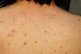 毛囊炎总是治不好？日常生活中需要注意哪些事项？图片