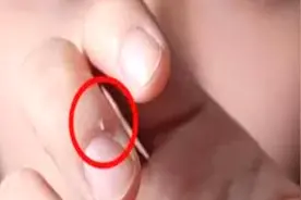 随意撕倒刺后果严重！告诉您四步简单安全处理它图片