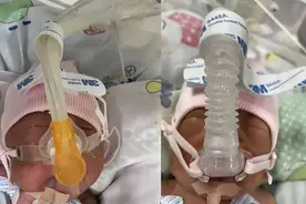 郑州：早产双胞胎患多病两个只能活一个？好消息来了：善款已到位图片