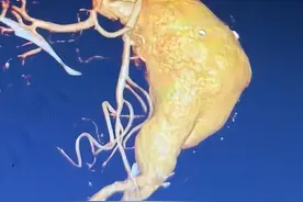 主动脉“爆雷”危及阿婆生命，苏州专家4小时成功“拆弹”！图片