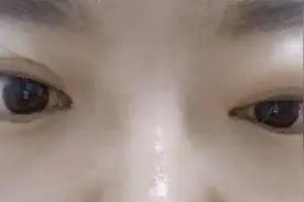 突眼的悲伤！分享三位20多岁花季少女患甲亢突眼辛酸实例图片