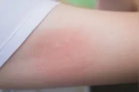 6种常见蚊虫咬伤的症状，怎么预防和治疗？一次给你讲清楚图片