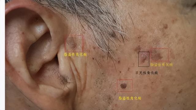 老年性角化病严重吗