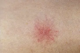 身上长这种小红痣，医生提醒：警惕肝硬化，尽早就诊图片