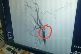 亲戚得脑血管病跟他生活中的坏习惯有关图片