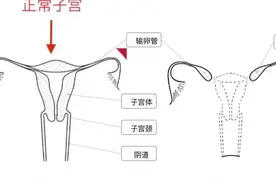 我没有子宫也没有阴道，是传说中的“石女”图片