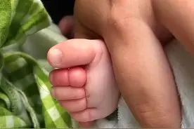 两个月大的宝宝险被截肢！罪魁祸首是一根头发，这些小事不可忽视图片