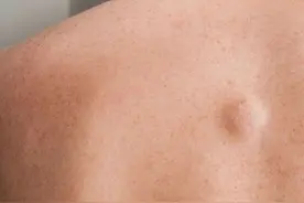 不痛不痒的“脂肪瘤”，需要治疗吗？图片