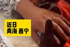 青海西宁：一烧伤患者急需手术，但戒指却牢牢卡在手指上，无法取下求助消防图片
