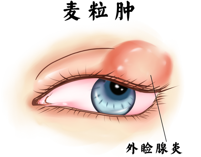 看了不该看的东西会长"针眼"?如何消肿才重要!