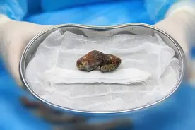 久病真能成医？带石生活5年，听听最有发言权的她怎么说图片