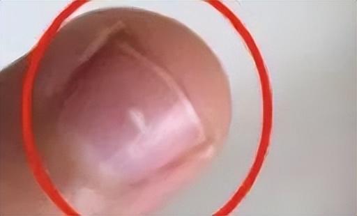 孩子指甲这4种表现是患病信号！第1种可能预示肿瘤