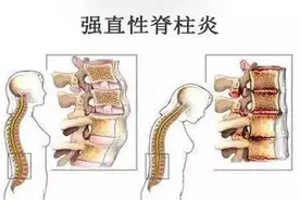 李宇春患强直性脊柱炎，疼到无法睡，强直性脊柱炎早期有哪些症状图片