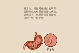 关于胃息肉形成的原因，医生一次性全告诉你图片