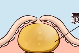 医生：大多数囊肿不用处理，但若出现在这3个地方，需要提高警惕图片