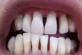 年纪大了，牙齿为什么会变长？真相后悔没有早点知道！图片