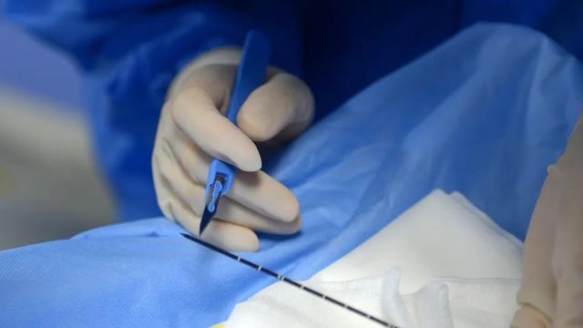 一根细针,解决多年肺结节困扰