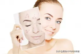 你是不是也不知道刷酸怎样才算结束？那你可得看看这篇文章了图片