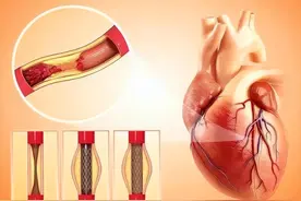 装上心脏支架后，还能活多少年呢？医生说出答案，或与你想得不同图片