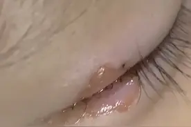 惊险！爸爸抽烟甩手不慎烫伤孩子眼睛图片