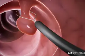 肠息肉切除后，多长时间复查比较合适？会复发吗？图片