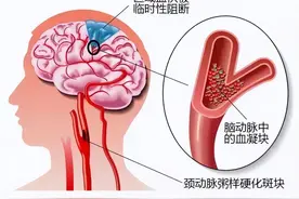 近2.7亿人有颈动脉斑块，3点预防措施！1种治疗方案！你必须看！图片