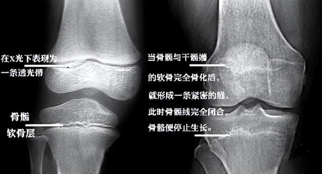 男孩女孩的骨骺线一般几岁闭合？