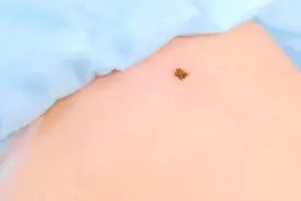 痣居然会癌变？能点掉吗？出现这5个特征，要当心图片