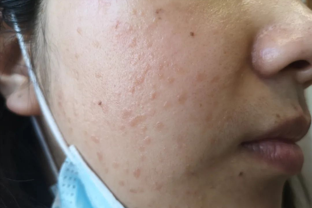 角化棘皮瘤的病理要点