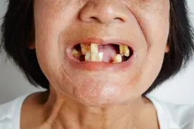 掉牙后最容易陷入的1个误区，太坑人！看看你中招了吗？图片