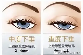 重症肌无力为啥老是眼睛先“背锅”？图片
