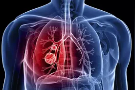 肺癌术后咳嗽，难道是肿瘤复发？医生：是否复发，看这4点症状图片