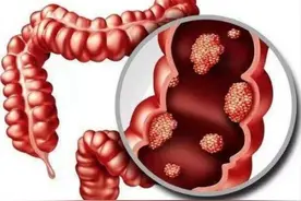 医生提醒：肠道有息肉的人，身体常出现这三个异常信号图片