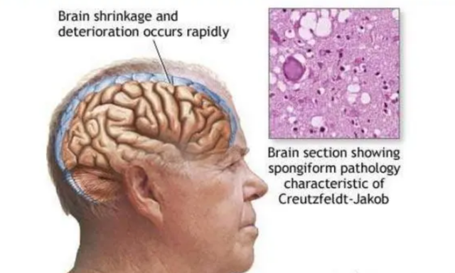 鐑圭叜閮芥潃涓嶆鐨勬湂鐥呮瘨锛岃嚧姝荤巼100%鏃犺嵂鍙晳锛佹劅鏌撳悗鏈夊鎭愭€栵紵