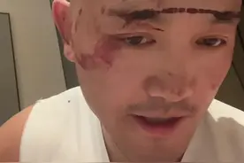 反转了！网红武僧一龙称被人偷袭缝20针，又发视频说撞树上了图片