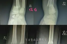 小孩骨折后需要手术吗？会留疤吗？家长们看完这篇文章后就放心啦图片