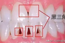 说到牙齿问题别只知道蛀牙！牙龈的“黑三角”才是牙医最头疼的图片