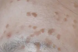 扁平疣是怎么引起的，如何治疗？图片