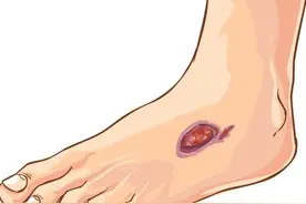 糖尿病足，一个伤不起的狠“脚”色！图片