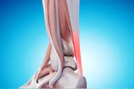 跟腱炎是怎么回事？医生给出了明确答案，不妨看看图片