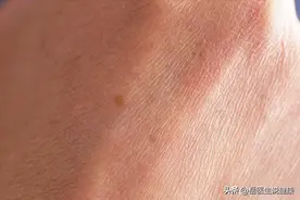 人为什么会长老人斑？红霉素软膏能够去除老人斑吗？不妨了解一下图片