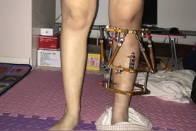 O型腿外固定支架矫正个人经历，严重O型腿可能会引起骨关节炎图片