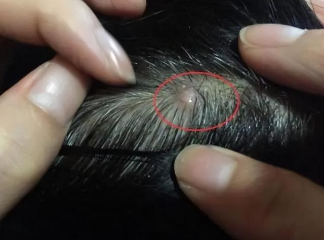 头皮上经常长脓包和小疙瘩,是咋回事?提醒:3种病要考虑在内