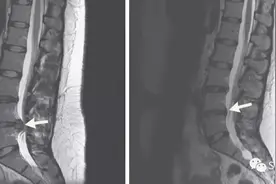 椎间盘突出自发重吸收图片