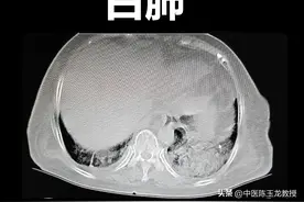 阳了后担心自己得白肺？五个中药方帮你消除后顾之忧图片
